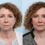 Lip Shortening Surgery before and after photos in Houston, TX, Patient 44029
