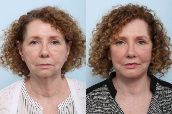 Facial Plastic Surgery before and after photos in Houston, TX