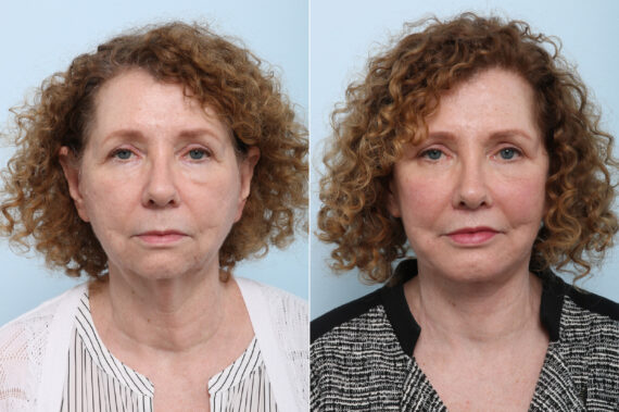 Lip Shortening Surgery before and after photos in Houston, TX, Patient 44029