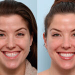 Botox® Cosmetic before and after photos in Houston, TX, Patient 47172