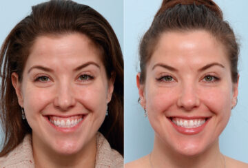 Xeomin / Botox® Cosmetic before and after photos in Houston, TX, Patient 47172