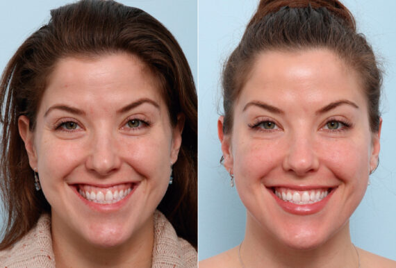 Botox® Cosmetic before and after photos in Houston, TX, Patient 47172