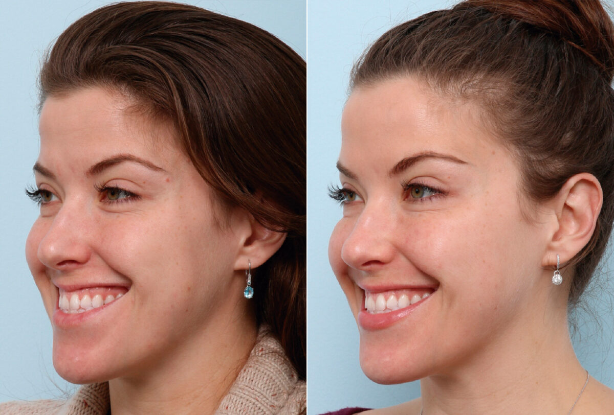Xeomin / Botox® Cosmetic before and after photos in Houston, TX, Patient 47172