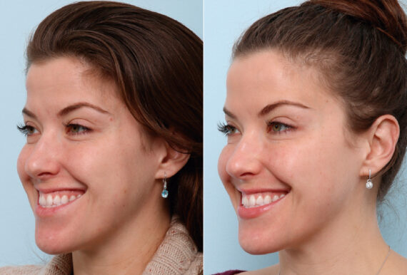 Xeomin / Botox® Cosmetic before and after photos in Houston, TX, Patient 47172