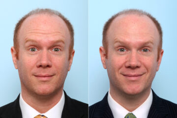 Xeomin / Botox® Cosmetic before and after photos in Houston, TX, Patient 47183