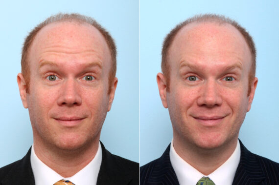 Xeomin / Botox® Cosmetic before and after photos in Houston, TX, Patient 47183