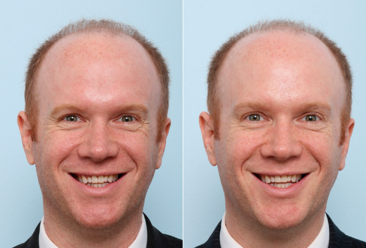Xeomin / Botox® Cosmetic before and after photos in Houston, TX, Patient 47183