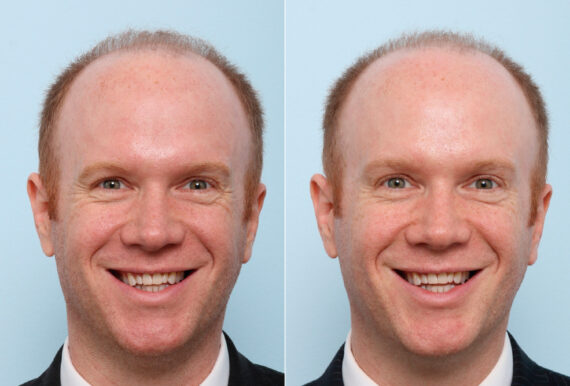 Xeomin / Botox® Cosmetic before and after photos in Houston, TX, Patient 47183