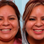 Botox® Cosmetic before and after photos in Houston, TX, Patient 47184