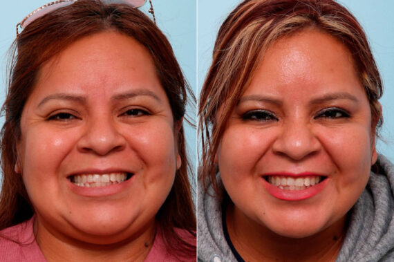 Botox® Cosmetic before and after photos in Houston, TX, Patient 47184