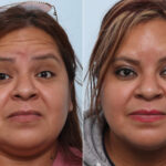 Botox® Cosmetic before and after photos in Houston, TX, Patient 47184