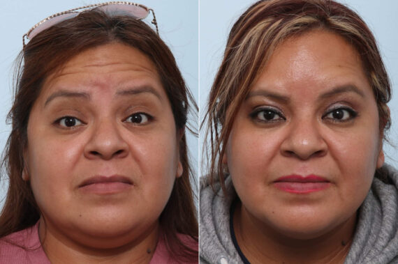 Xeomin / Botox® Cosmetic before and after photos in Houston, TX, Patient 47184