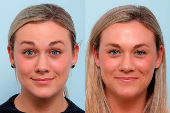 Xeomin / Botox® Cosmetic before and after photos in Houston, TX, Patient 47185
