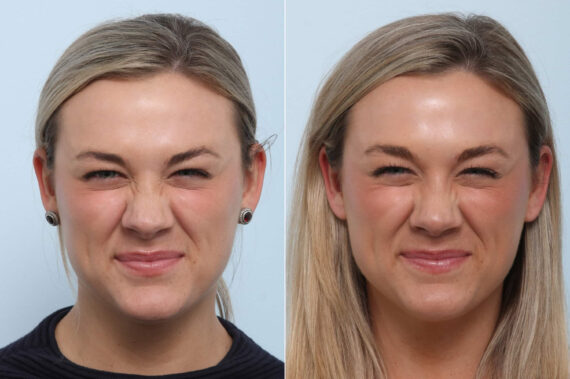 Xeomin / Botox® Cosmetic before and after photos in Houston, TX, Patient 47185