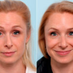 Botox® Cosmetic before and after photos in Houston, TX, Patient 47186