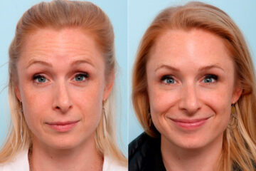 Botox® Cosmetic before and after photos in Houston, TX, Patient 47186