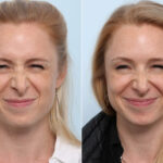 Botox® Cosmetic before and after photos in Houston, TX, Patient 47186