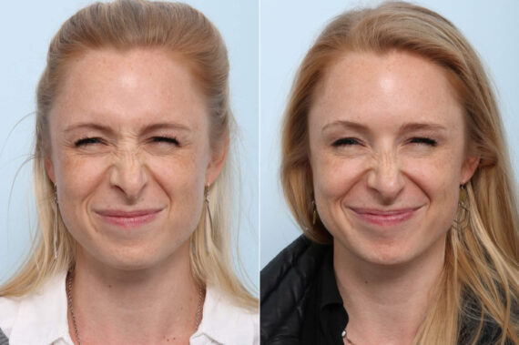 Xeomin / Botox® Cosmetic before and after photos in Houston, TX, Patient 47186