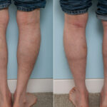 Calf Implants before and after photos in Houston, TX, Patient 47332