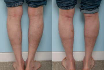 Calf Implants before and after photos in Houston, TX, Patient 47332