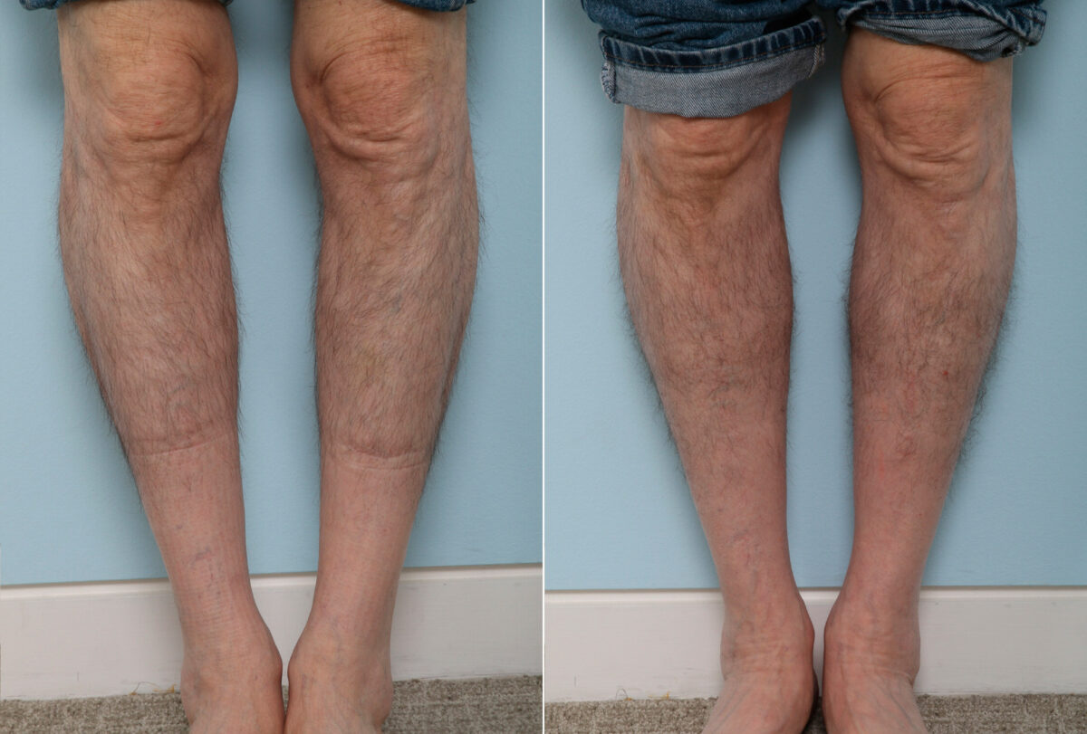 Calf Implants before and after photos in Houston, TX, Patient 47332