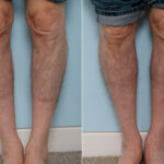 Calf Implants before and after photos in Houston, TX, Patient 47332