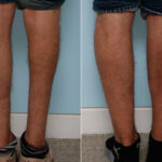 Calf Implants before and after photos in Houston, TX, Patient 47339