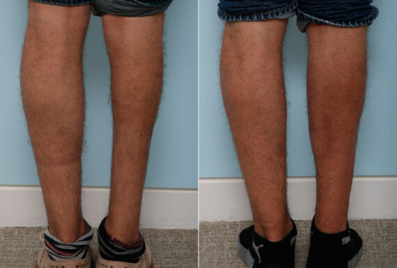 Calf Implants before and after photos in Houston, TX, Patient 47339