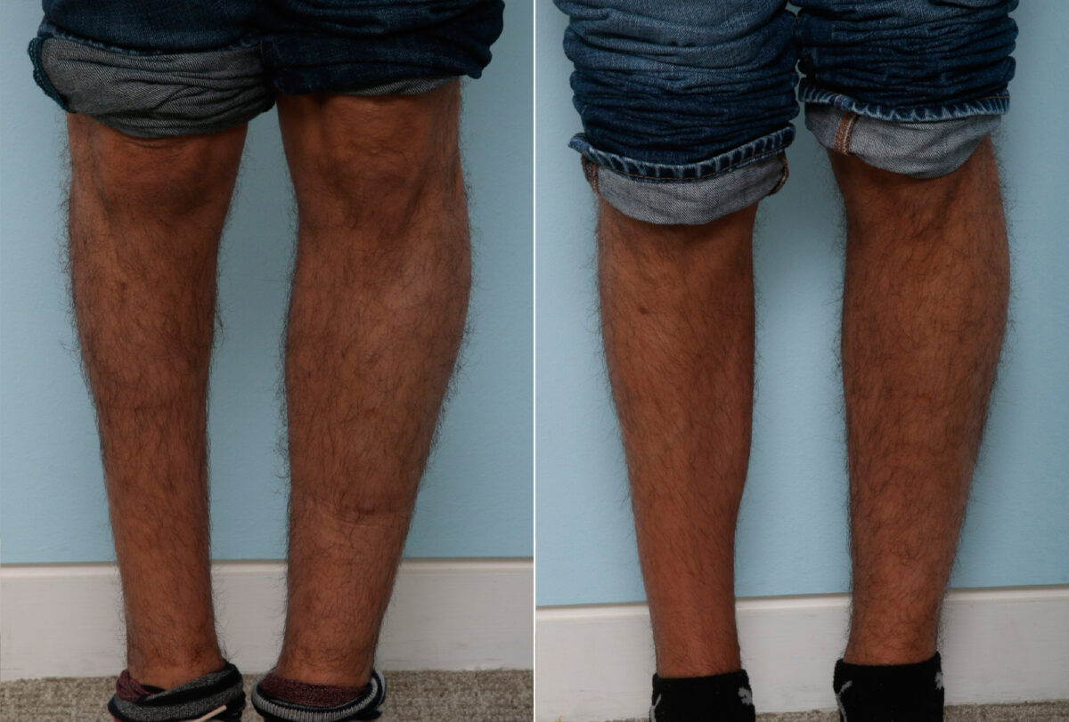 Calf Implants before and after photos in Houston, TX, Patient 47339