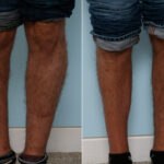 Calf Implants before and after photos in Houston, TX, Patient 47339