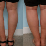 Calf Implants before and after photos in Houston, TX, Patient 47346