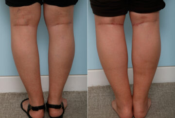 Calf Implants before and after photos in Houston, TX, Patient 47346