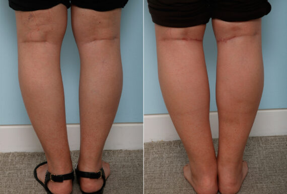 Calf Implants before and after photos in Houston, TX, Patient 47346