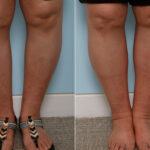 Calf Implants before and after photos in Houston, TX, Patient 47346