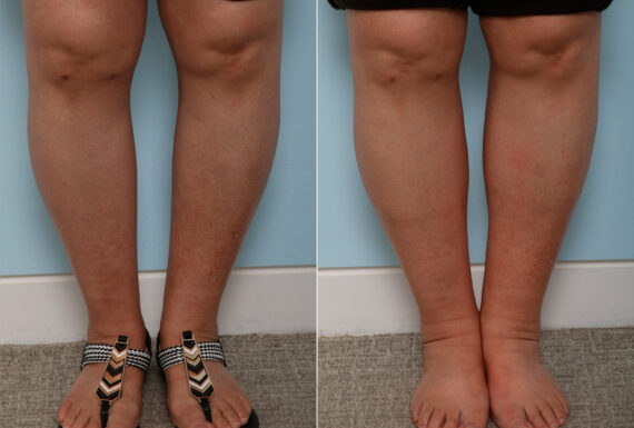 Calf Implants before and after photos in Houston, TX, Patient 47346
