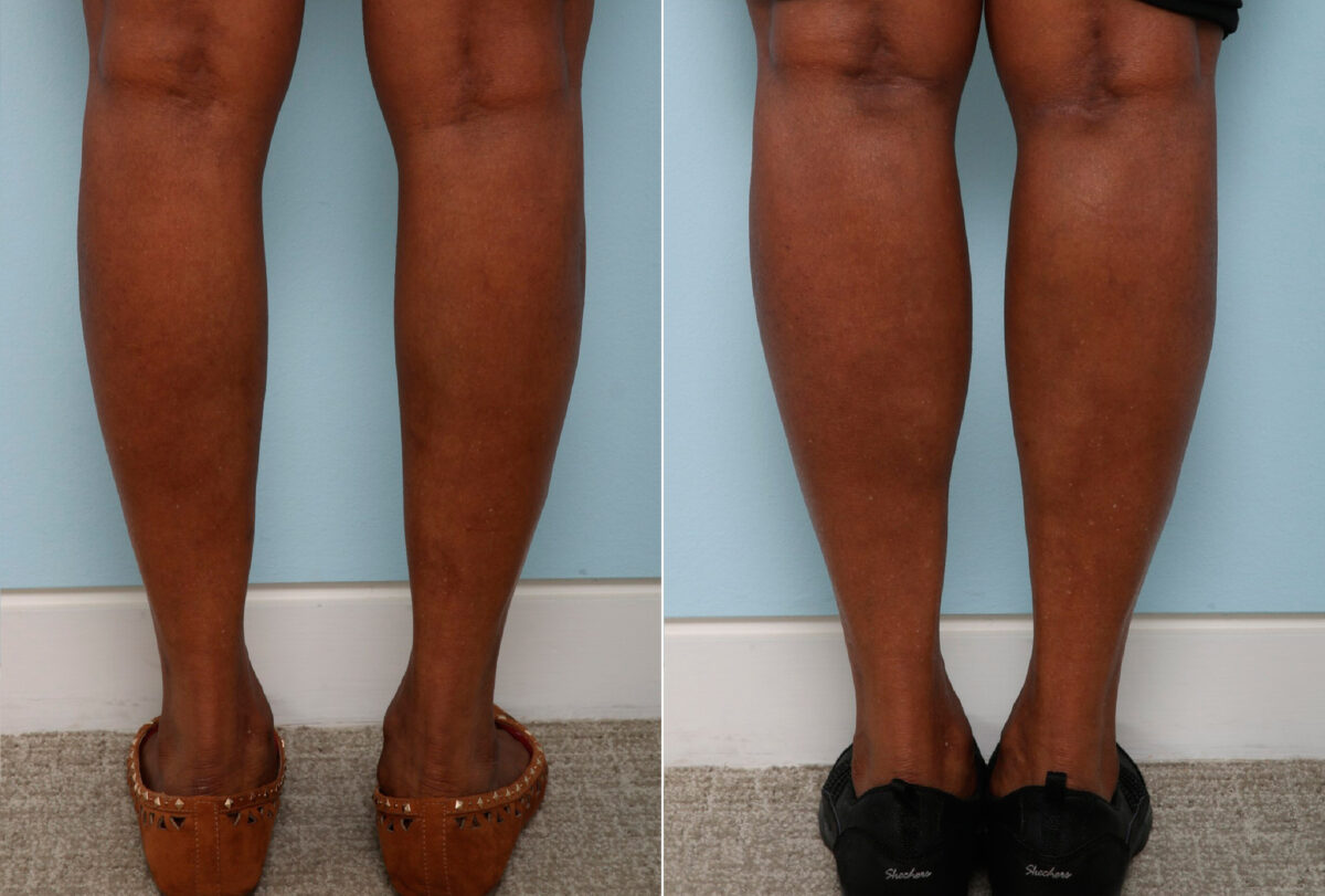 Calf Implants before and after photos in Houston, TX, Patient 47353