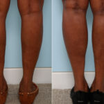 Calf Implants before and after photos in Houston, TX, Patient 47353