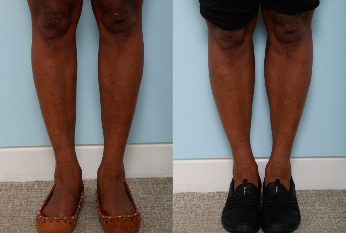 Calf Implants before and after photos in Houston, TX, Patient 47353