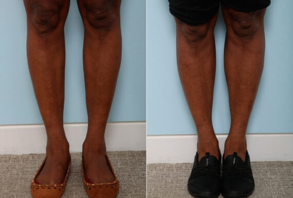 Calf Implants before and after photos in Houston, TX, Patient 47353