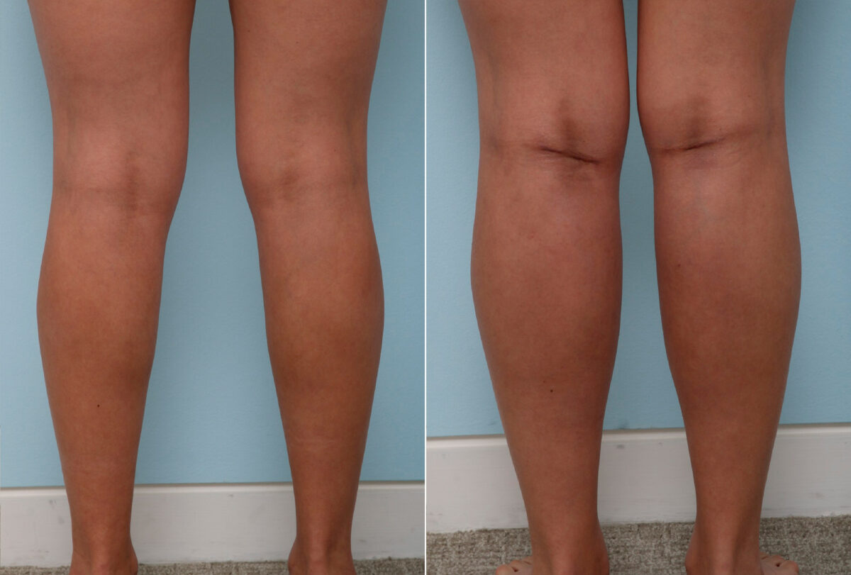 Calf Implants before and after photos in Houston, TX, Patient 47360