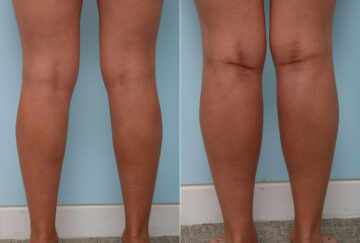 Calf Implants before and after photos in Houston, TX, Patient 47360