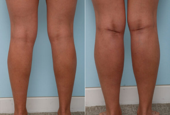 Calf Implants before and after photos in Houston, TX