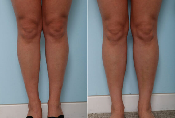 Calf Implants before and after photos in Houston, TX, Patient 47360