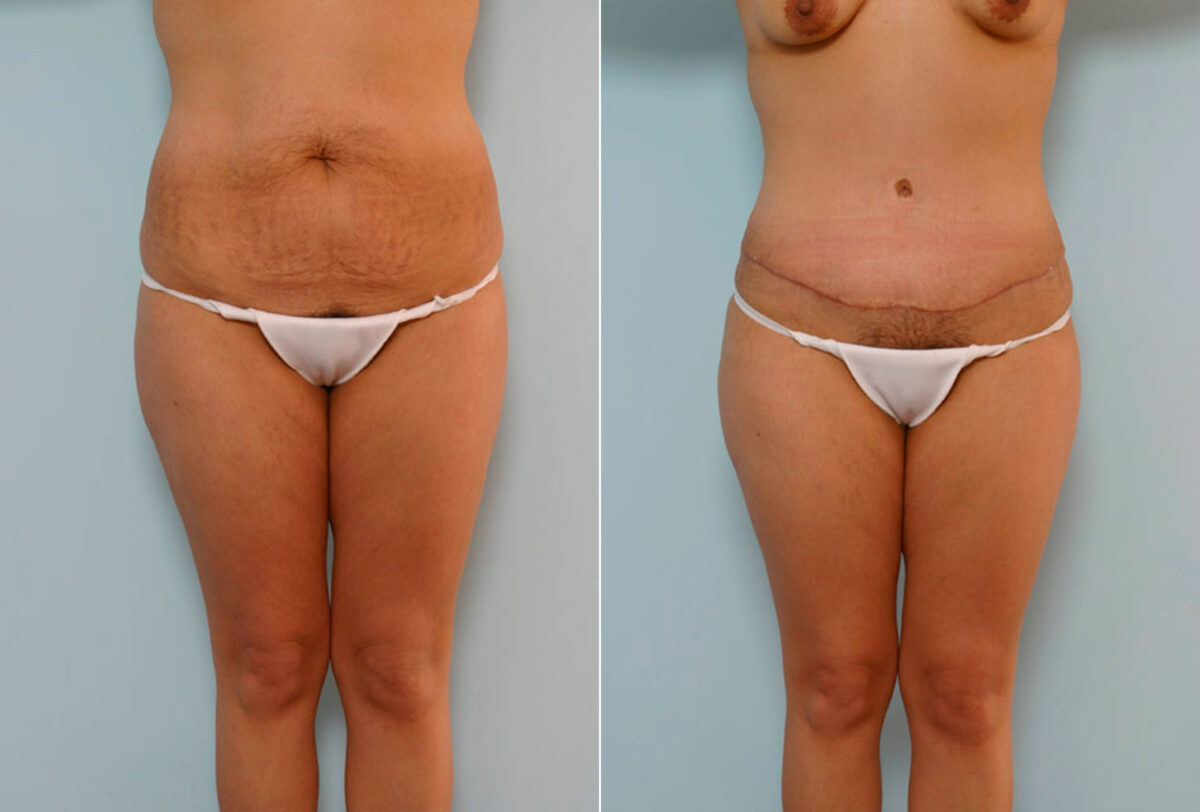 Tummy Tuck/Abdominoplasty before and after photos in Houston, TX, Patient 24261