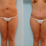 Abdominoplasty before and after photos in Houston, TX, Patient 24261