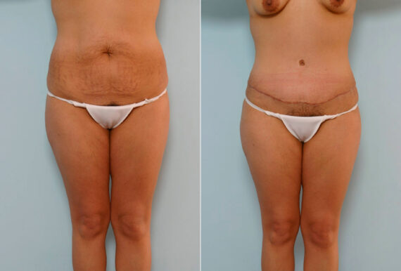 Tummy Tuck/Abdominoplasty before and after photos in Houston, TX, Patient 24261