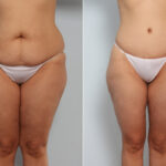 Body Lift before and after photos in Houston, TX, Patient 56918