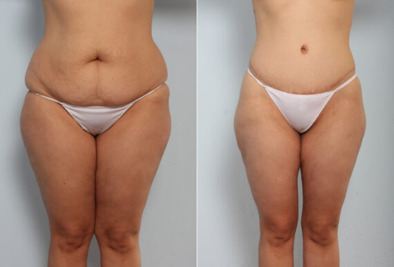 Body Lift before and after photos in Houston, TX, Patient 56918