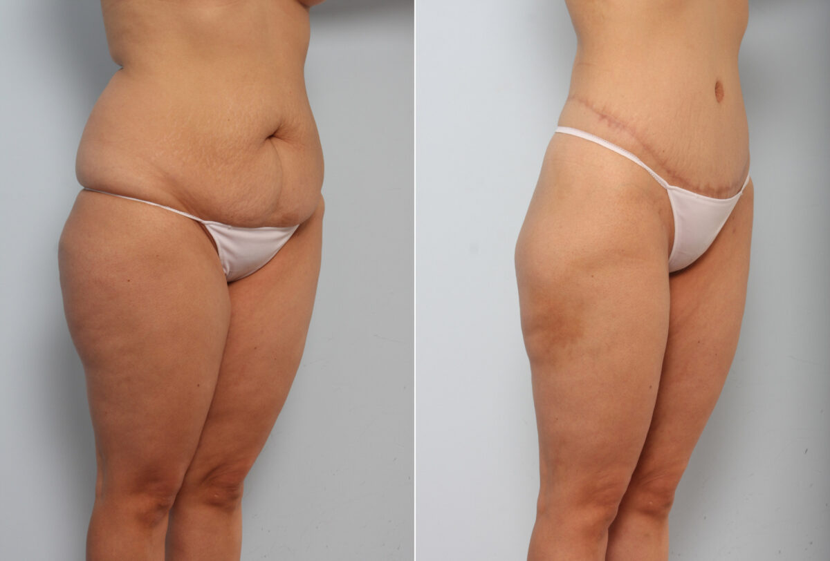 Body Lift before and after photos in Houston, TX, Patient 56918