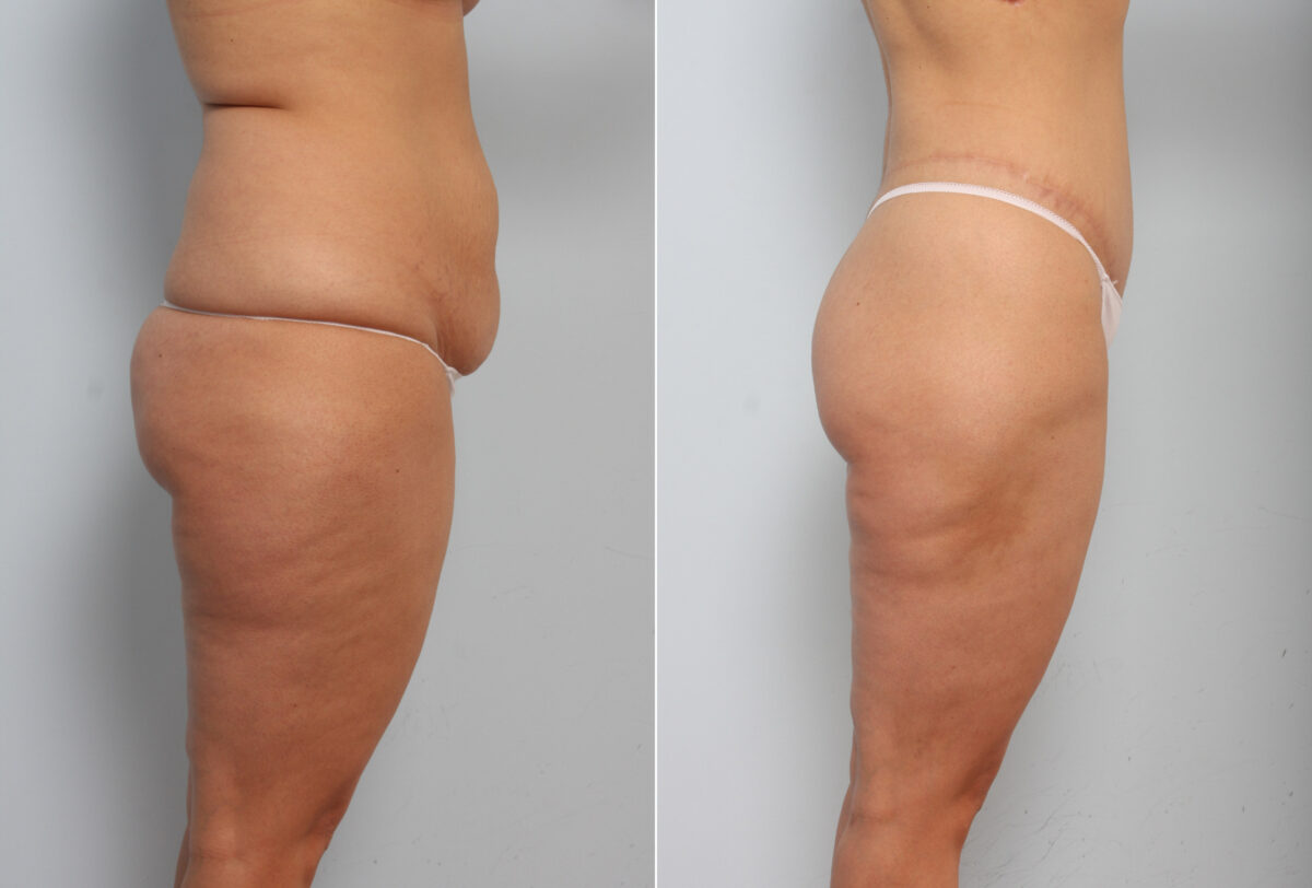 Body Lift before and after photos in Houston, TX, Patient 56918